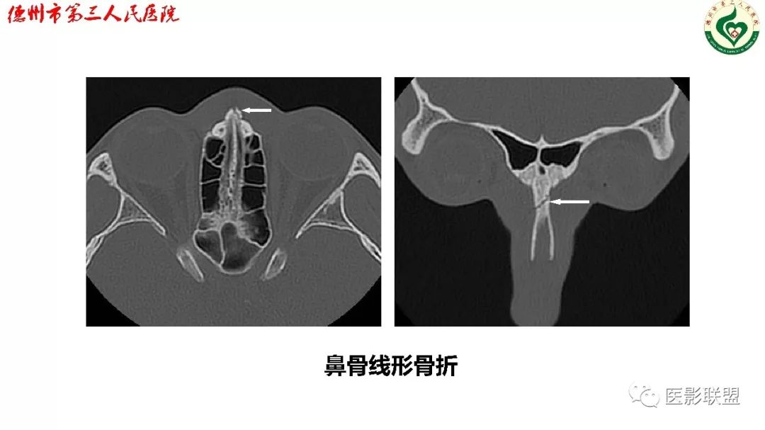 鼻骨骨折影像,鼻骨骨折dr影像表现