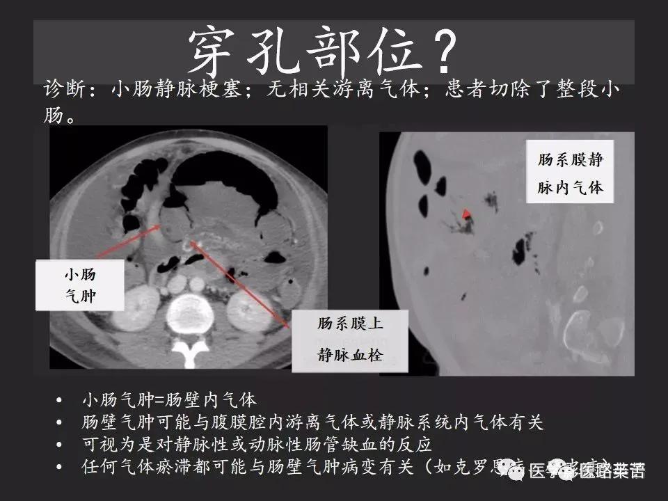 空腔脏器穿孔和胃肠道穿孔区别,腹膜后穿孔一般是哪里穿孔