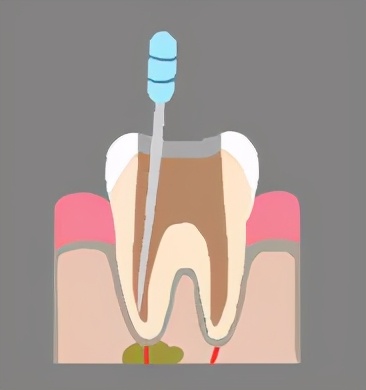 根管治疗是不是就是杀死神经,根管第一次封药是杀神经吗