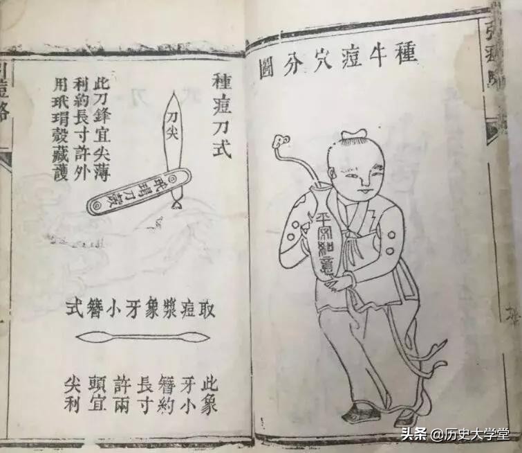 人类消灭天花是个奇迹,人类为什么可以消灭天花