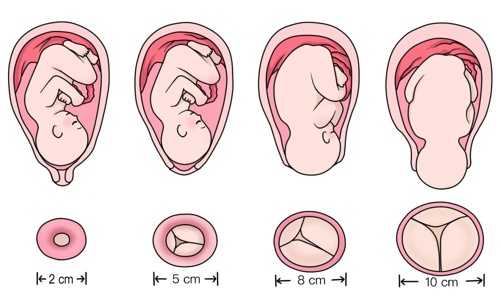 开宫口十指胎儿进入产道了吗,开宫口是顺产的必备条件吗