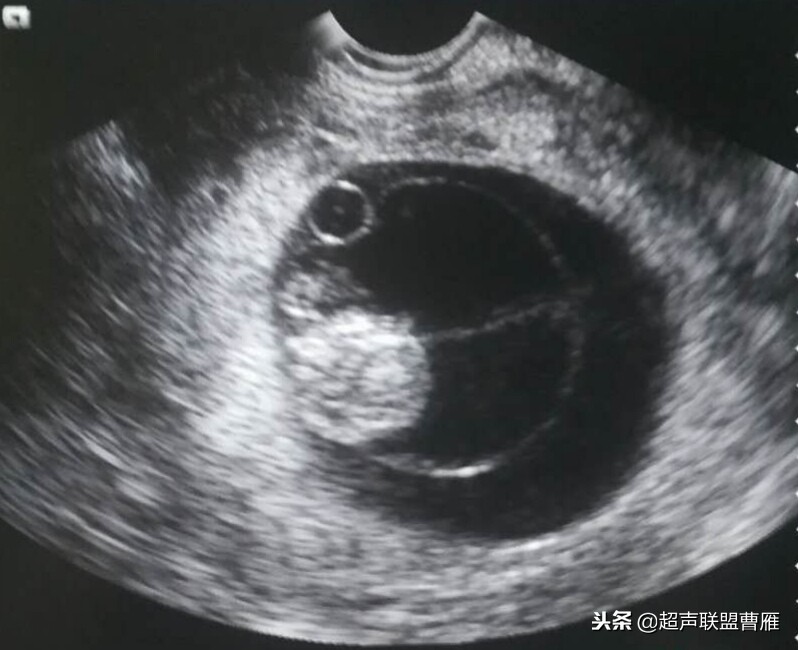 3毫米卵黄囊未见胎芽正常么,40多天的卵黄囊