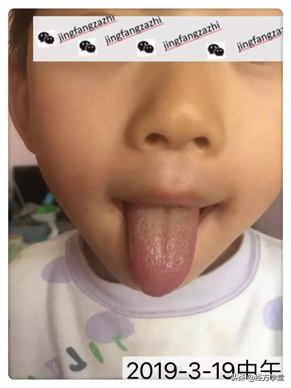 小柴胡汤加升降散医案,小柴胡颗粒治感冒后期咳嗽