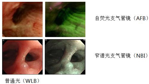 支气管镜高频电刀治疗中央型肺癌,支气管镜在早期肺癌诊断的意义