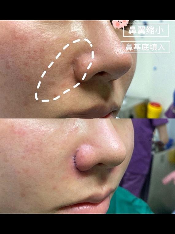 鼻基底填充好还是假体好,为什么垫鼻子要用肋骨