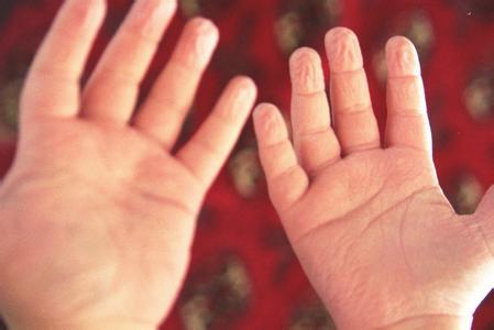 每年春季手指起泡脱皮,春季手指脱皮是怎么回事