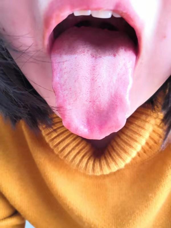 中药治疗腮腺炎、低热患者病案1例（1周）