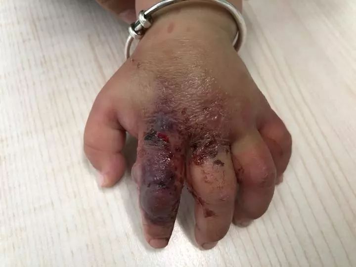 被蚊子咬了止痒神器药店,被蚊子咬了去药店买什么药