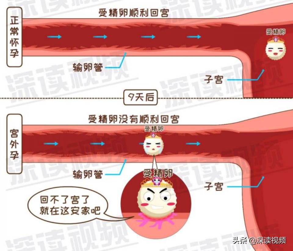 宫外孕出血量和月经一样怎么回事,宫外孕是怎么回事能不能再生孩子