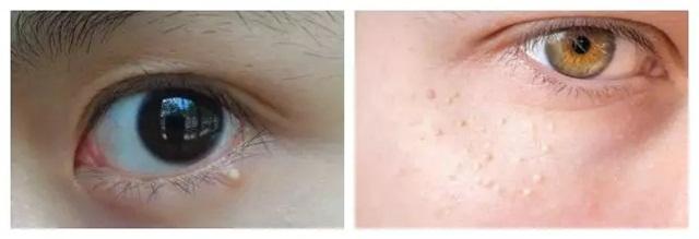 脂肪粒白头怎么去,脂肪粒去除小妙招皮肤