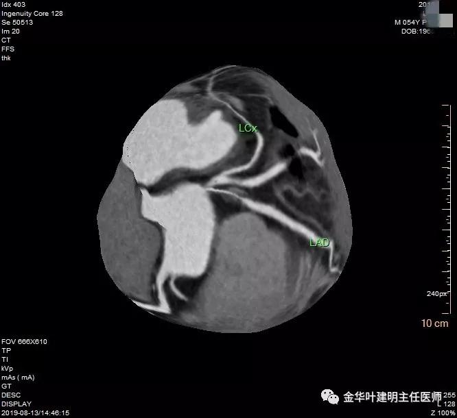 省级医院也漏诊?还好没耽误病情!我们予以行右中下叶袖式切除术
