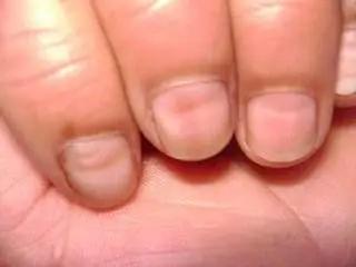 儿童指甲白斑坑洼不平是什么原因,8-12岁儿童指甲白斑是什么原因