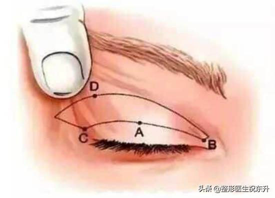 上眼皮松弛下垂做什么手术不留疤,提眉和上眼睑松弛矫正有啥区别