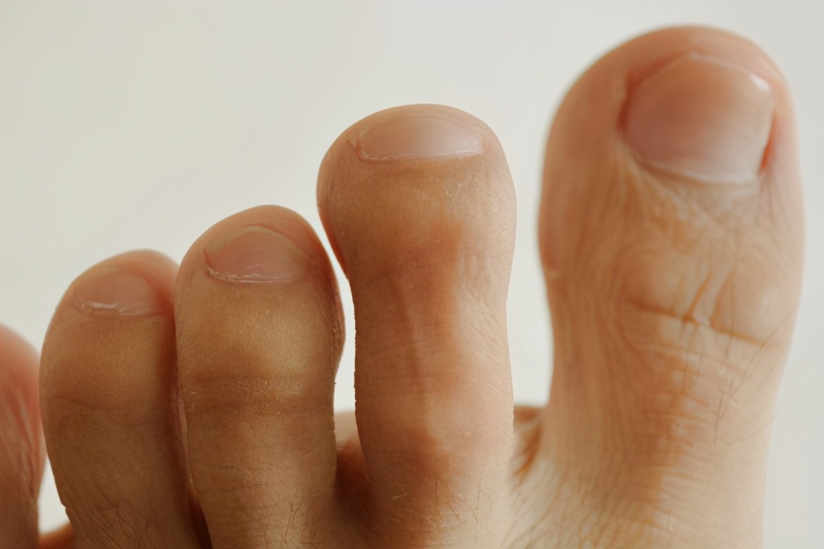 脚趾甲沟炎冒出一坨肉,脚趾甲老是往肉里长怎么矫正