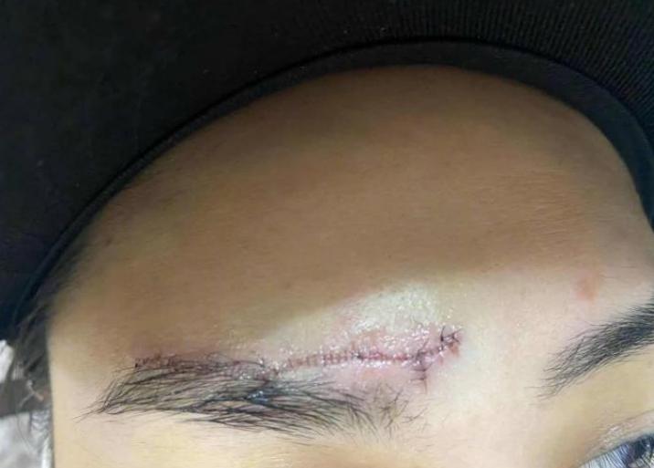 阿娇伤后首露面图片,阿娇晒出额头受伤照片