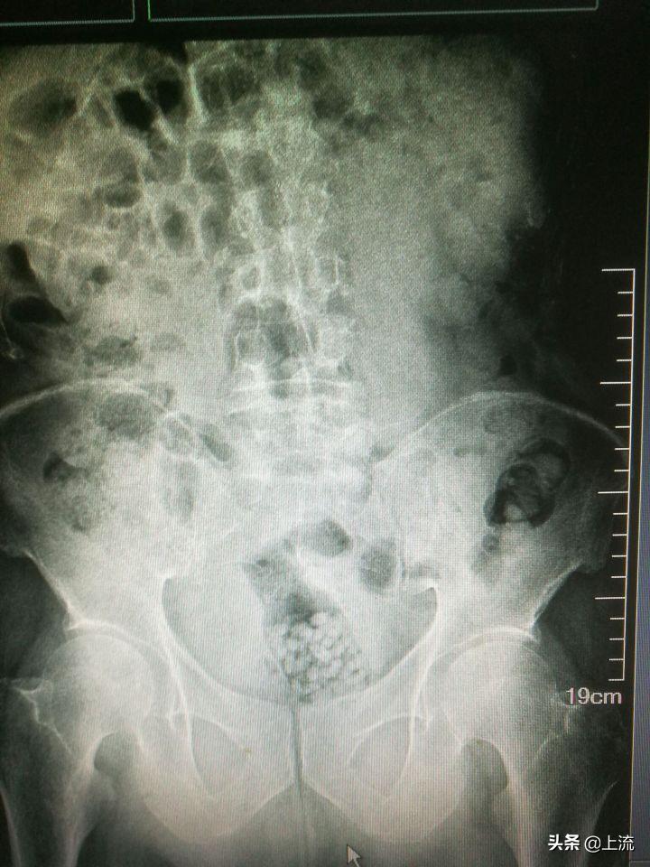 肛肠科医生的手指为什么这么粗,肛肠科医生用手指做检查