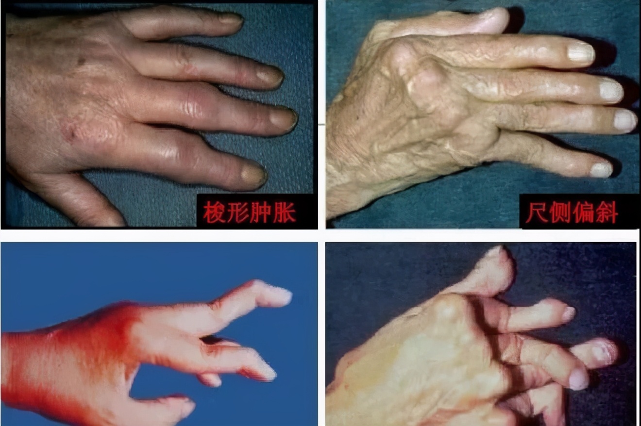 10月12日世界关节炎日义诊宣传,送温暖健康义诊