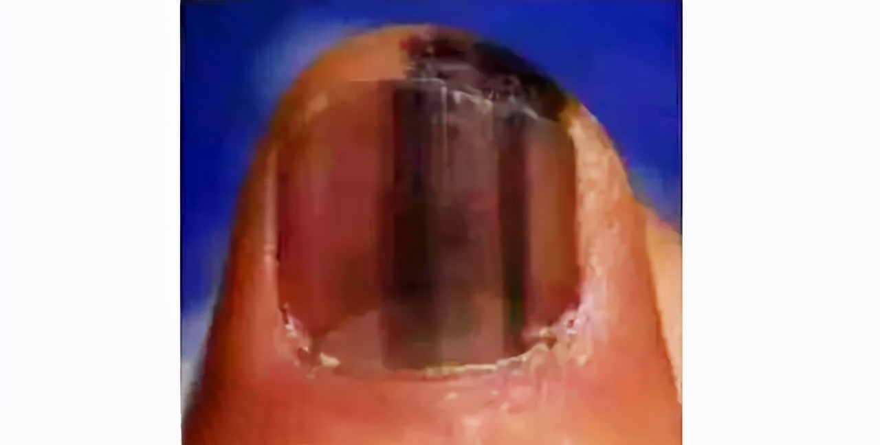 从手指指甲看出身体健康,指趾甲疾病是什么