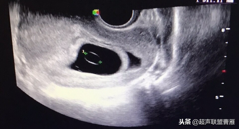 3毫米卵黄囊未见胎芽正常么,40多天的卵黄囊