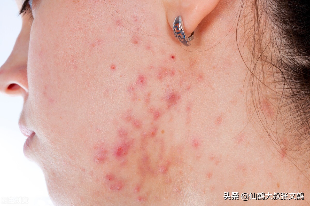 国际痘痘指南,痘痘等级划分标准图