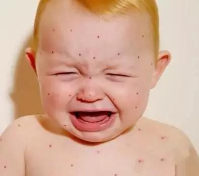 同济治湿疹的药,孩子湿疹去中法同济挂什么科