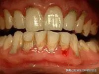 牙缝大是福是祸,牙缝宽什么命运