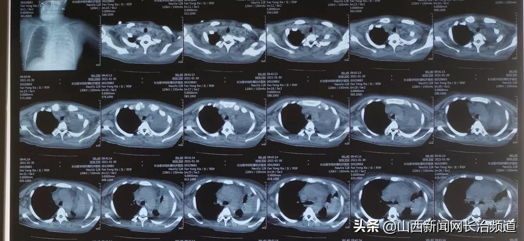 “与狼共舞”不再是梦——长治医学院附属和济医院肾内科救治一例肾衰竭合并脑出血患者