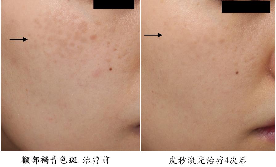 皮秒激光祛斑能保护表皮不受损伤,超皮秒激光祛斑的危害与效果视频