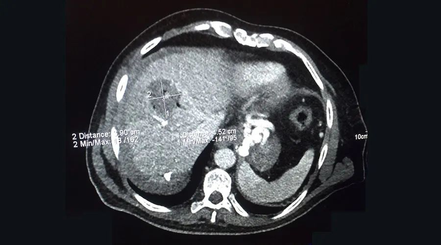 赛诺微射频消融仪,赛诺微射频消融