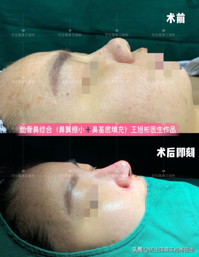 鼻中隔重塑鼻头,鼻中隔重建整形