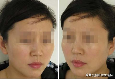 鐗欓娇澶栧嚫涓嬪反鍚庣缉鎬庝箞鐭,涓颁笅宸村彲浠ユ敼鍠勭墮榻垮悗缂╁悧