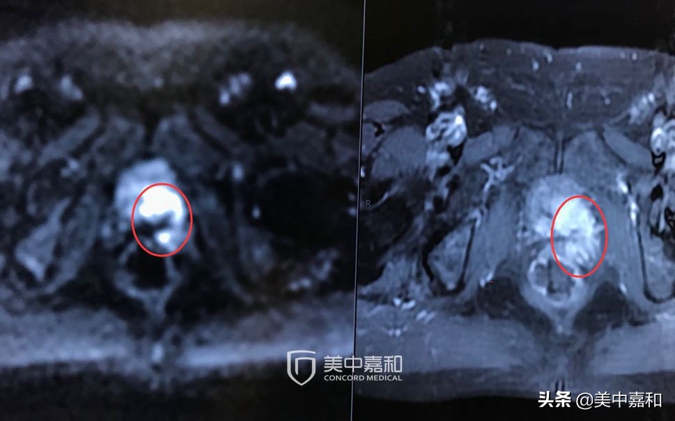 癌症根治性手术后，能“根治不复发”吗？