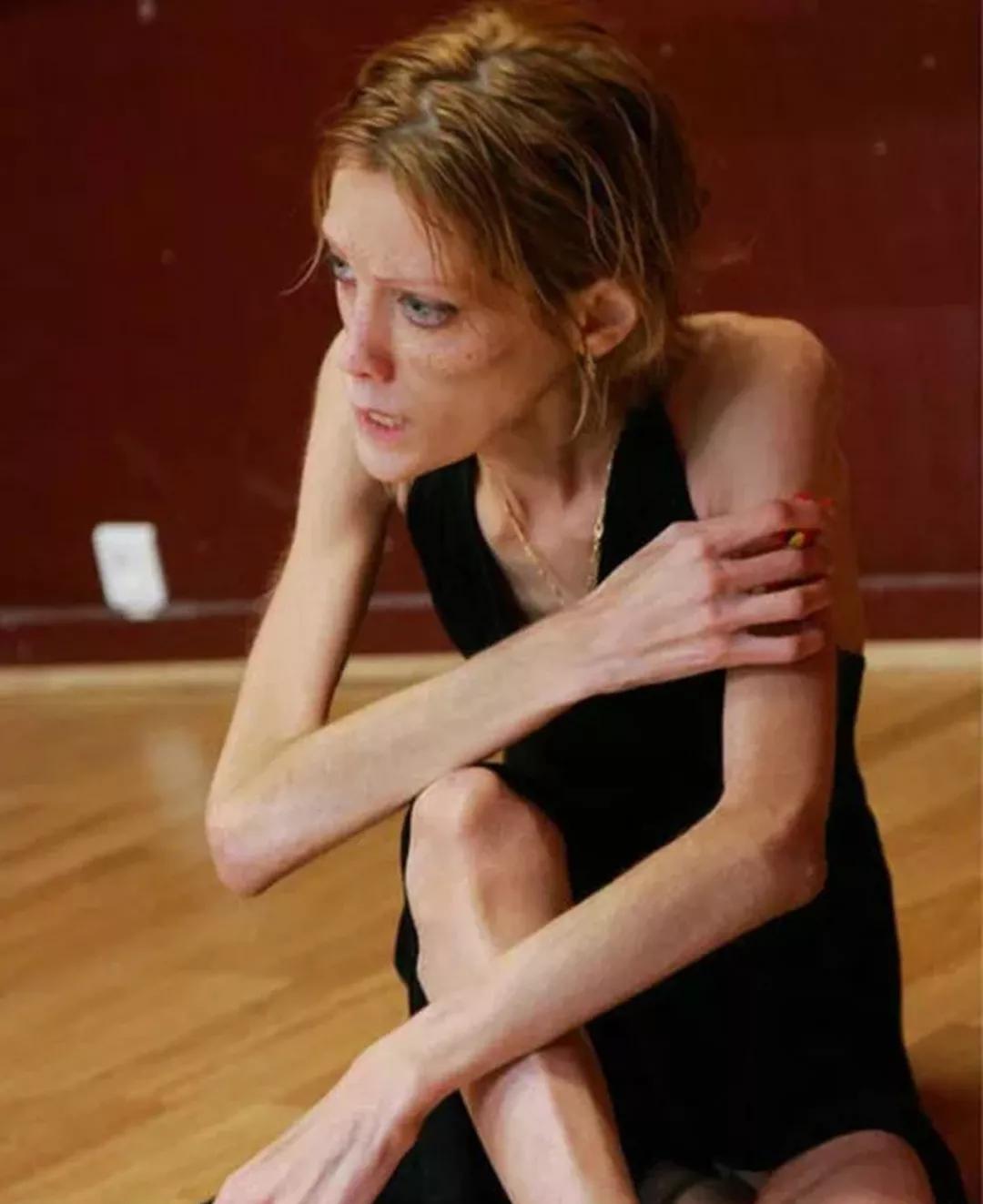 女模特去世时23斤,女模特去世身体只有23斤