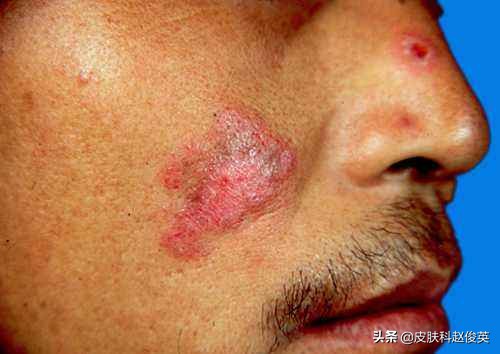 屠呦呦研究的青蒿素与红斑狼疮,屠呦呦青蒿素对红斑狼疮最新研究