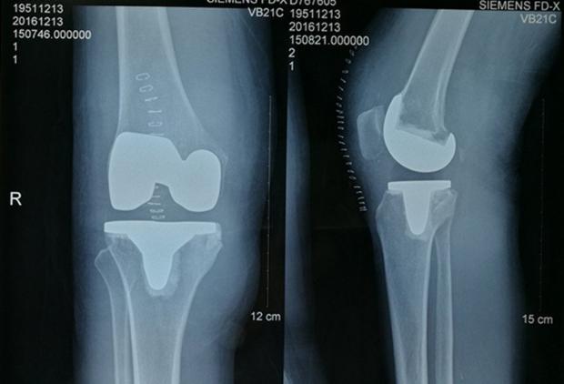 合肥康华医院康复训练怎么样,合肥膝关节置换哪家医院好