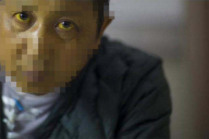 宋·窦材灸法医案赏析(6)——艾灸命关、关元治伤寒太阴阴黄证