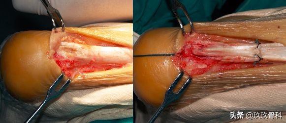 陈旧性踝关节损伤的治疗,踝关节损伤现场处理视频