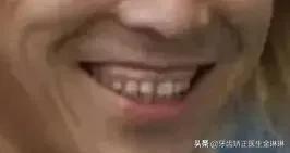 成年人露龈笑怎么矫正,如何矫正露龈笑嘴突