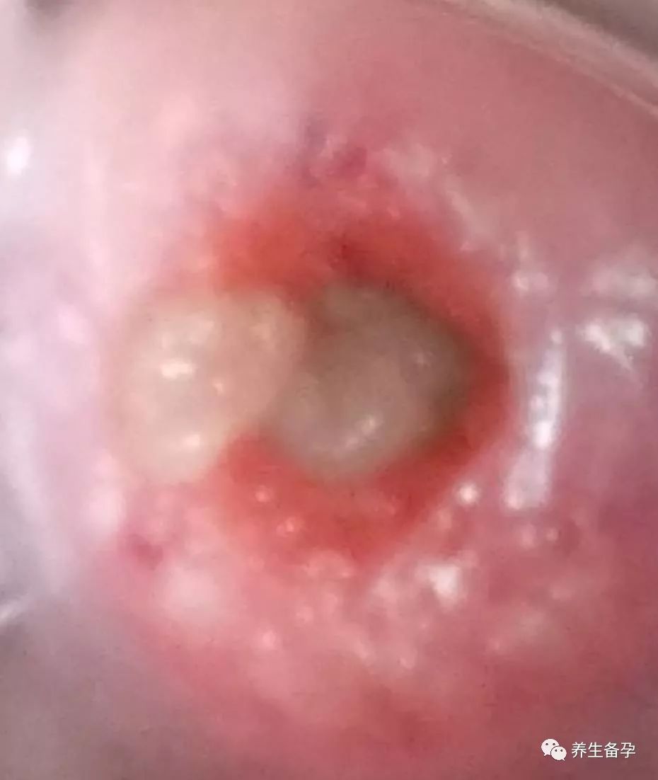 精子被堵在起跑线了的原因