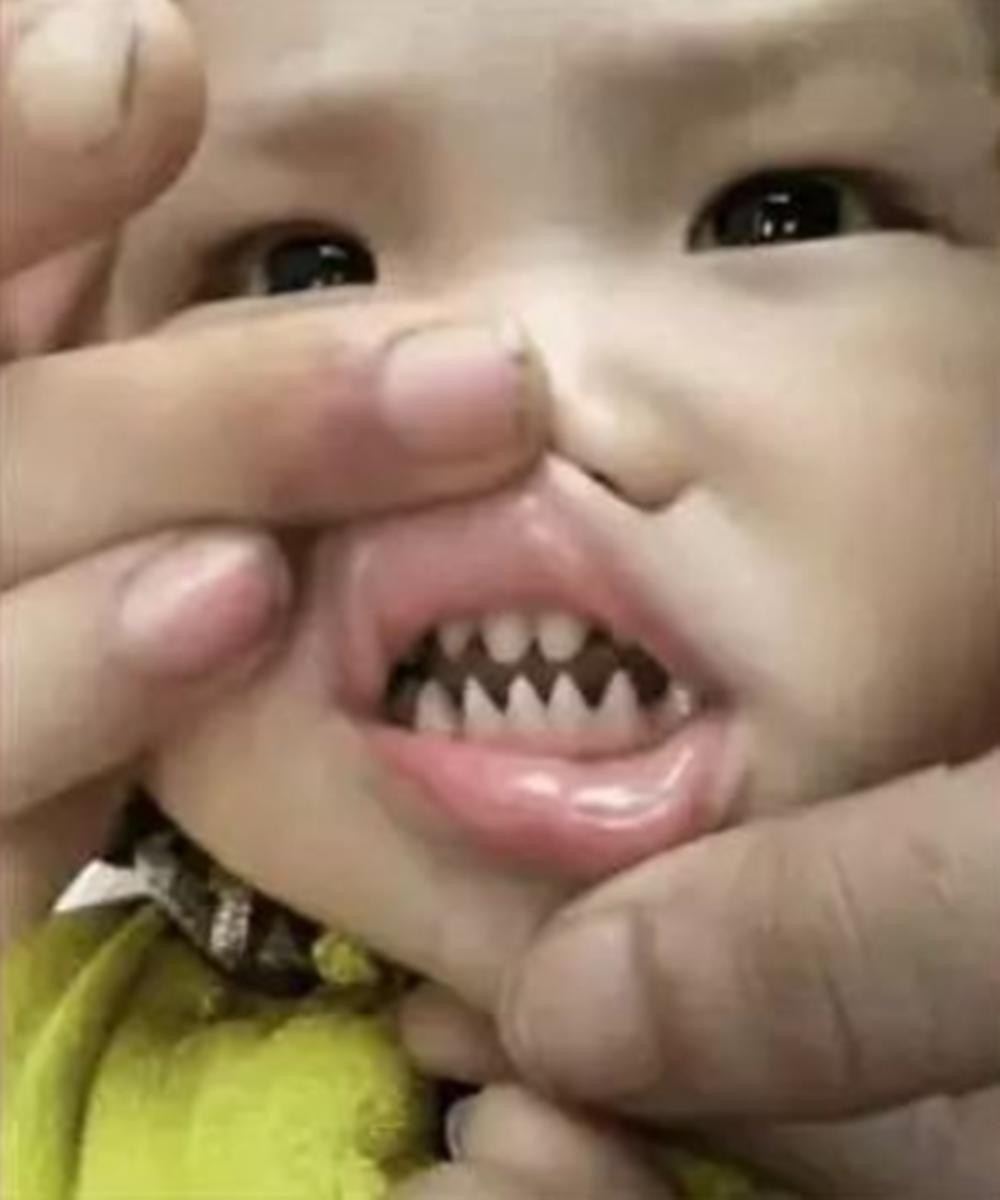小孩长了鲨鱼牙怎么办,孩子长鲨鱼牙齿的原因