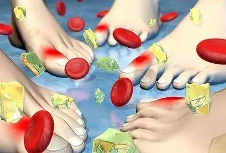 痛风发作期苯溴马隆的正确吃法,痛风治疗专家讲解