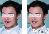 门牙撞了怎么办,门牙碎了你怎么办