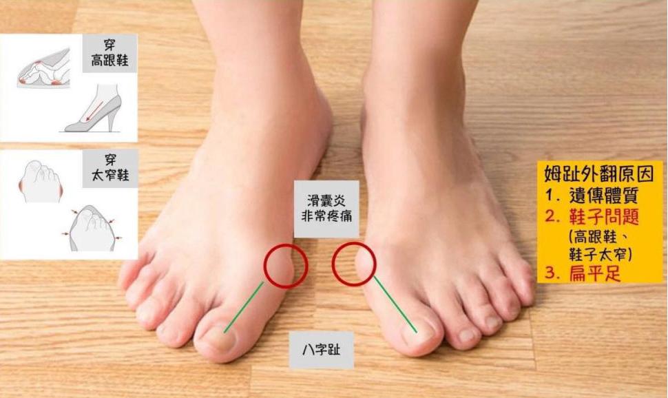 脚拇趾外翻矫正手法图解,脚拇趾外翻手术流程怎样