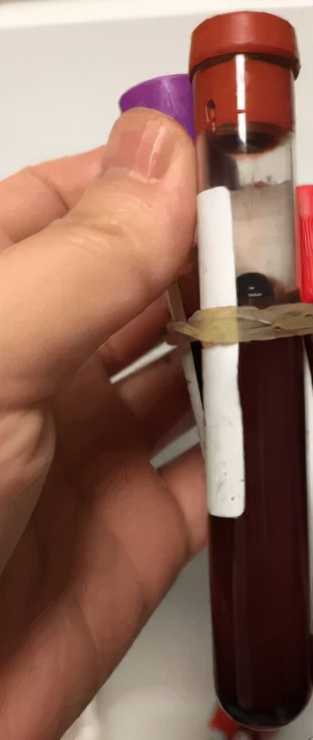 咳嗽10多天了有白痰细菌感染,咳嗽是肺部真菌感染吗