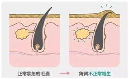 毛囊炎加鸡皮肤怎么根治,鸡皮肤和鱼鳞病怎样根治