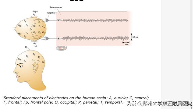 婴儿脑电图检查的危害,什么病要用脑电图检查
