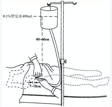 灌肠容易肠道破裂吗,灌肠可以把肠管捅破吗