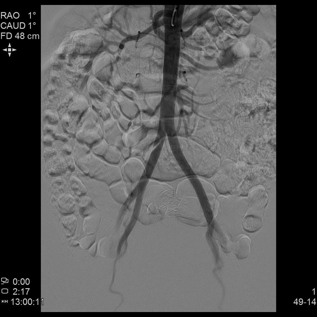子宫腺肌症「不死的癌症」——介入栓塞来帮忙
