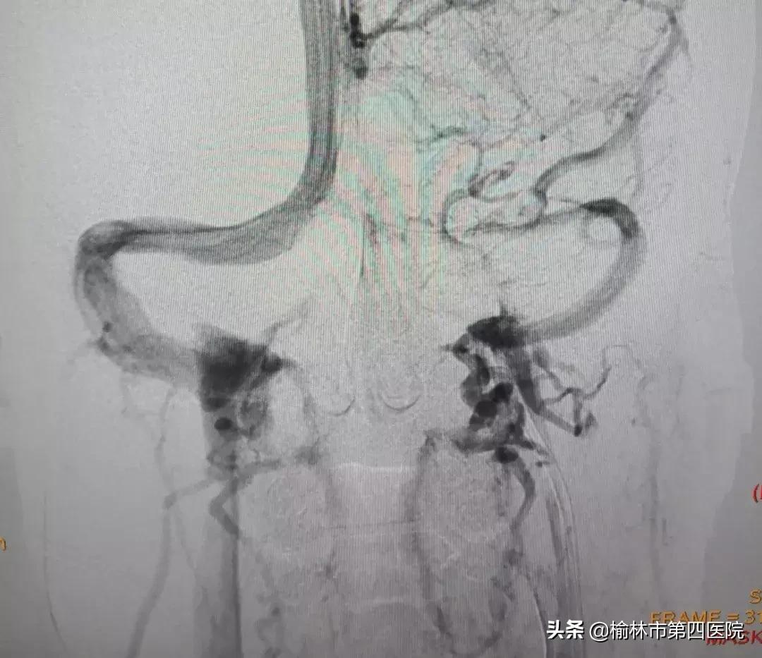成功开展内瘘狭窄球囊扩张术,静脉窦狭窄手术