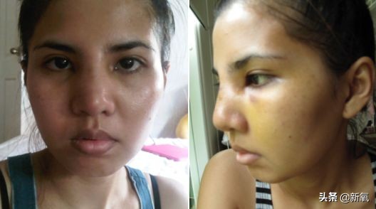 18岁土肥圆豪掷800万全身整形，鼻子6次大整假体穿出，效果却超美